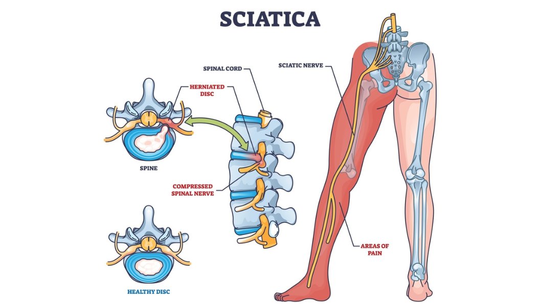 keep in mind when working out with sciatica